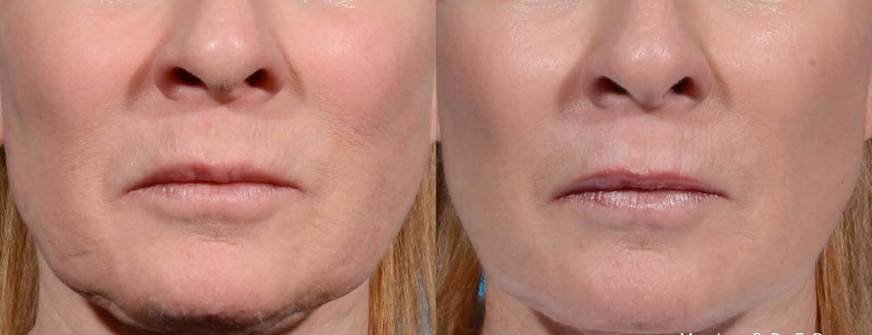 03cf584f-ed-facetitem8-1a-chin_10o80ag0o809b00000k028