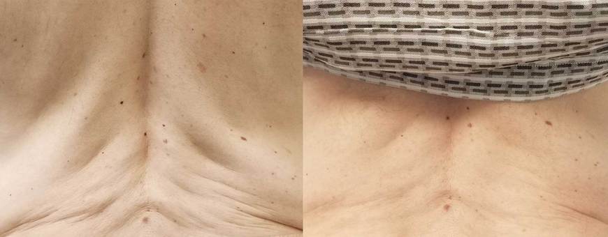 5f28ac16-ak-morpheus8-2-back_10o90aj0o609g003000028